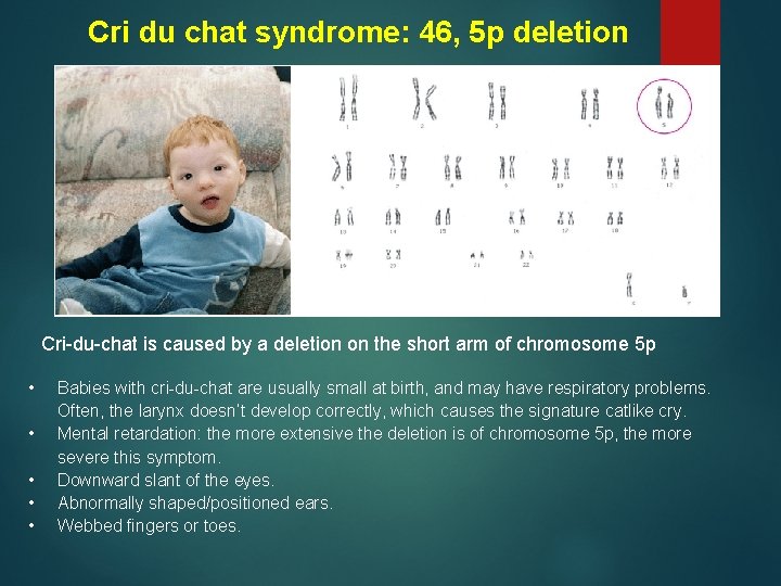 Cri du chat syndrome: 46, 5 p deletion Cri-du-chat is caused by a deletion
