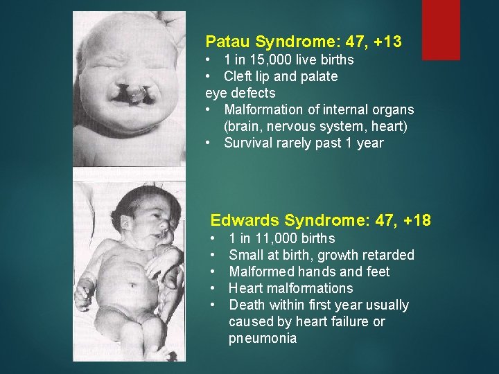 Patau Syndrome: 47, +13 • 1 in 15, 000 live births • Cleft lip