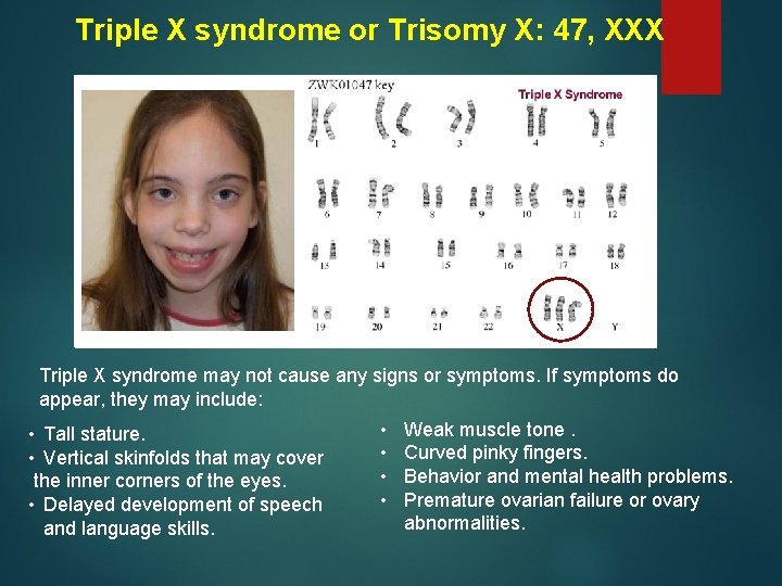 Triple X syndrome or Trisomy X: 47, XXX Triple X syndrome may not cause