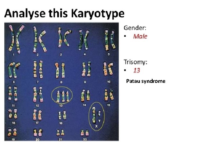 Patau syndrome 