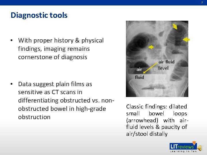 7 Diagnostic tools (SBO) • With proper history & physical findings, imaging remains cornerstone