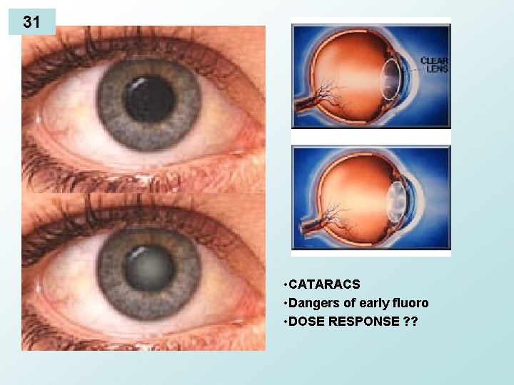 31 • CATARACS • Dangers of early fluoro • DOSE RESPONSE ? ? 