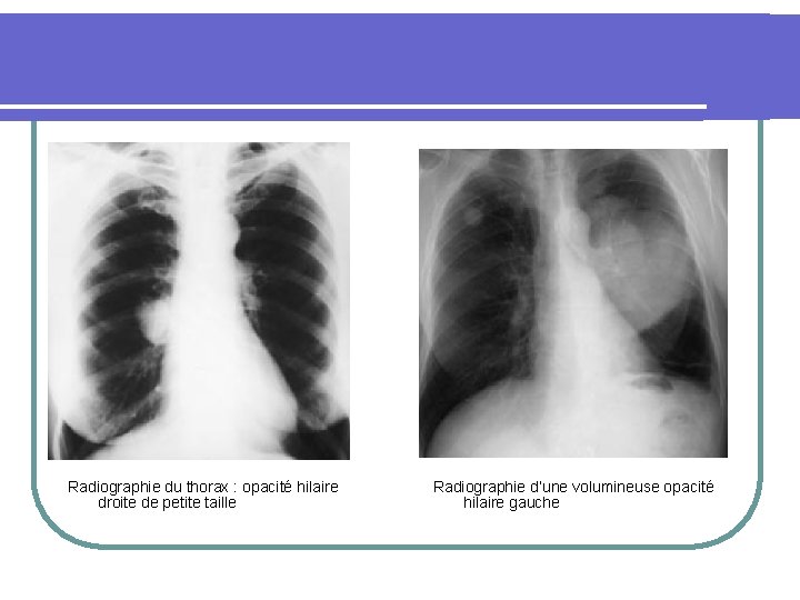 Radiographie du thorax : opacité hilaire droite de petite taille Radiographie d’une volumineuse opacité