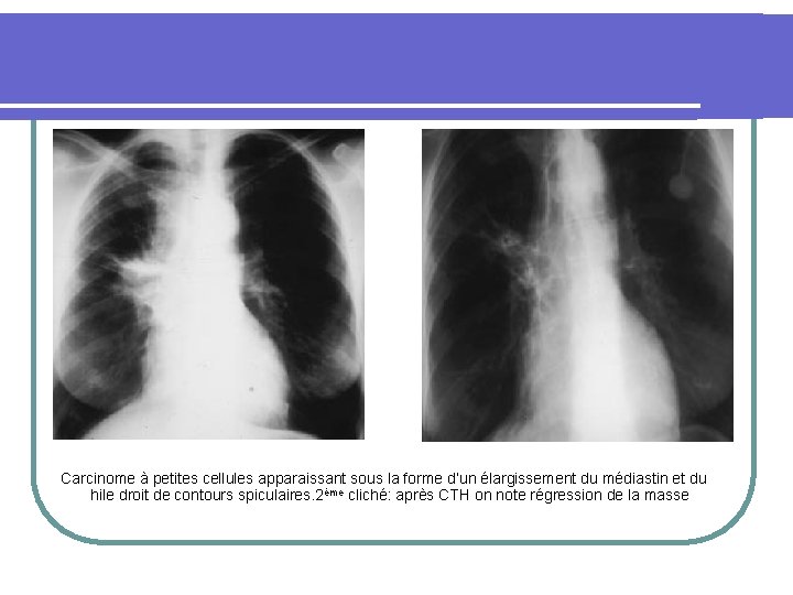 Carcinome à petites cellules apparaissant sous la forme d’un élargissement du médiastin et du