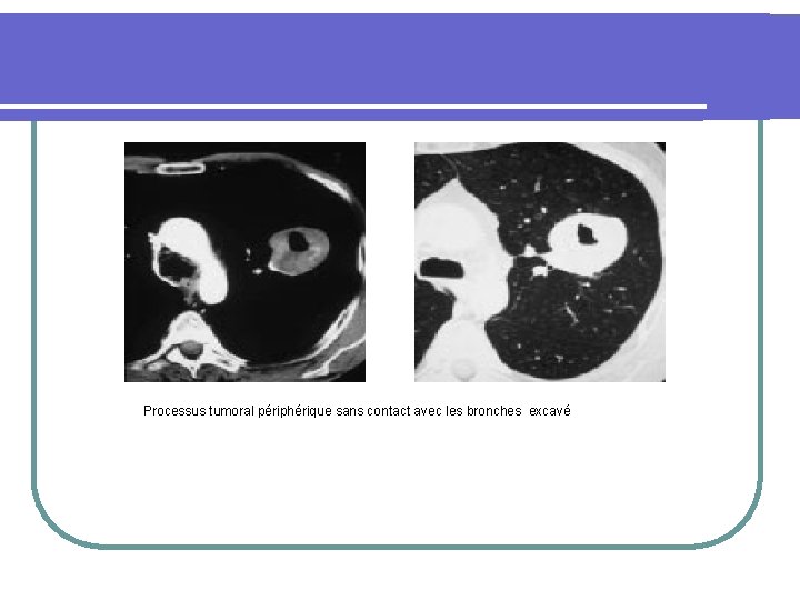 Processus tumoral périphérique sans contact avec les bronches excavé 