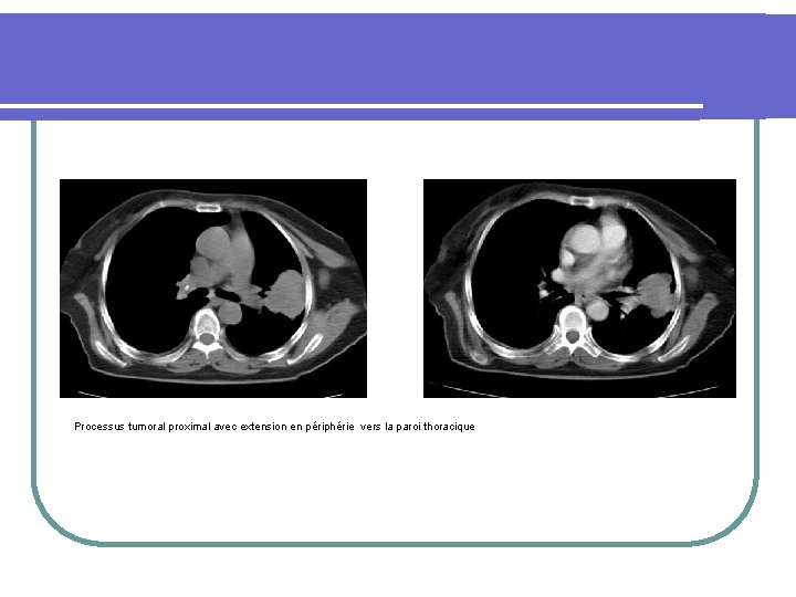 Processus tumoral proximal avec extension en périphérie vers la paroi thoracique 