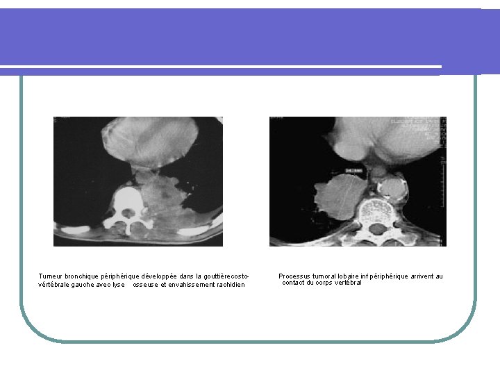  Tumeur bronchique périphérique développée dans la gouttière costovértébrale gauche avec lyse osseuse et