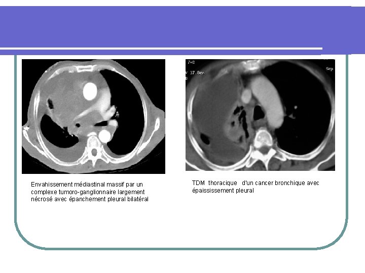 Envahissement médiastinal massif par un complexe tumoro-ganglionnaire largement nécrosé avec épanchement pleural bilatéral TDM