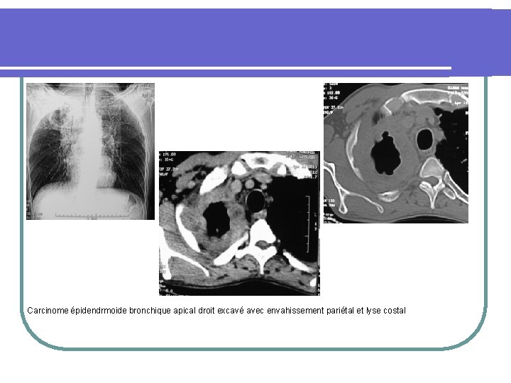 Carcinome épidendrmoide bronchique apical droit excavé avec envahissement pariétal et lyse costal 