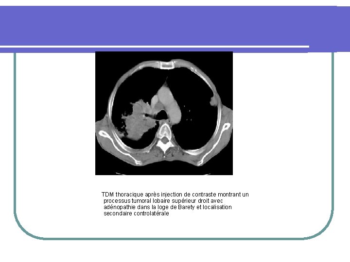  TDM thoracique après injection de contraste montrant un processus tumoral lobaire supérieur droit