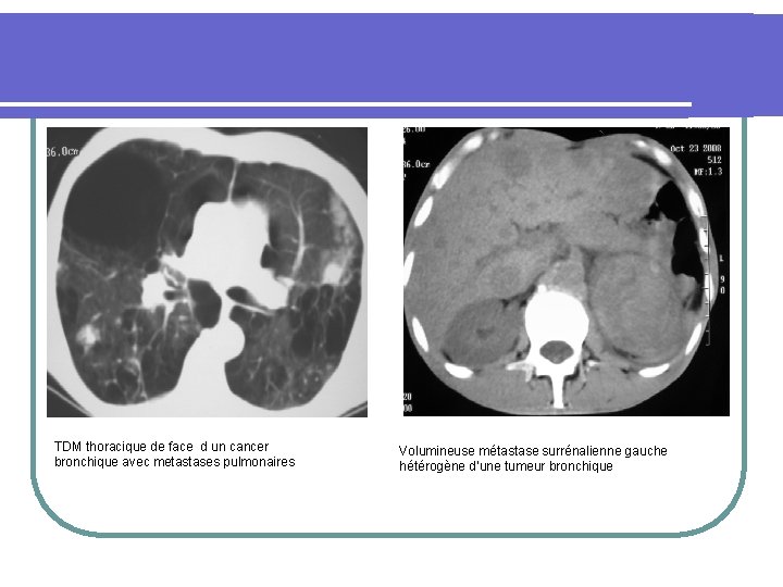 TDM thoracique de face d un cancer bronchique avec metastases pulmonaires Volumineuse métastase surrénalienne