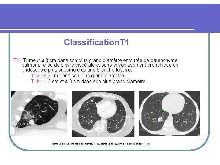 Classification. T 1 : Tumeur ≤ 3 cm dans son plus grand diamètre