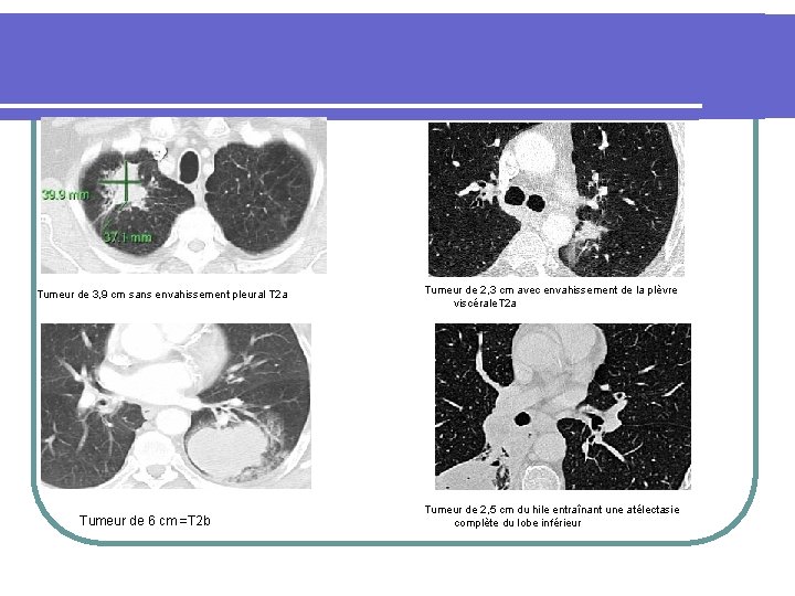 Tumeur de 3, 9 cm sans envahissement pleural T 2 a Tumeur de 6