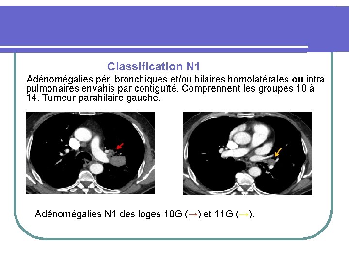  Classification N 1 Adénomégalies péri bronchiques et/ou hilaires homolatérales ou intra pulmonaires envahis