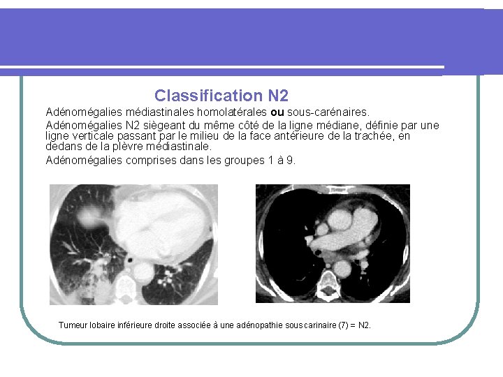  Classification N 2 Adénomégalies médiastinales homolatérales ou sous-carénaires. Adénomégalies N 2 siègeant du