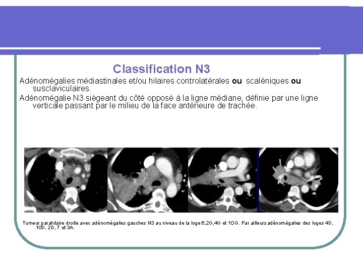  Classification N 3 Adénomégalies médiastinales et/ou hilaires controlatérales ou scaléniques ou susclaviculaires. Adénomégalie