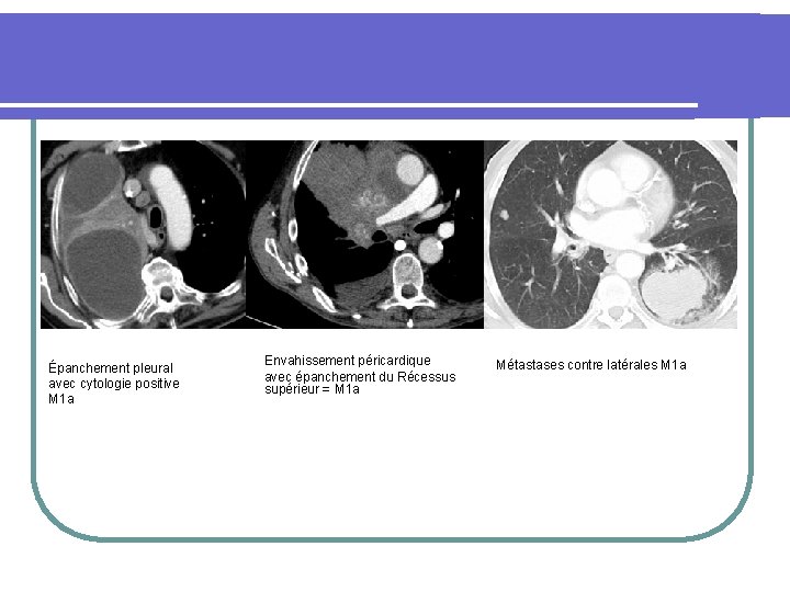 l Classification M 1 a Envahissement péricardique Métastases contre latérales M 1 a Épanchement
