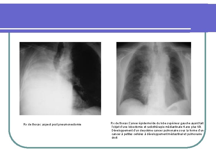 Rx de thorax: aspect post pneumonectomie Rx de thorax: Cancer épidermoïde du lobe supérieur