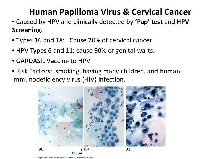 Human Papilloma Virus & Cervical Cancer • Caused by HPV and clinically detected by