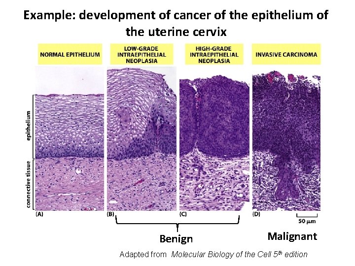 Example: development of cancer of the epithelium of the uterine cervix Benign Malignant Adapted