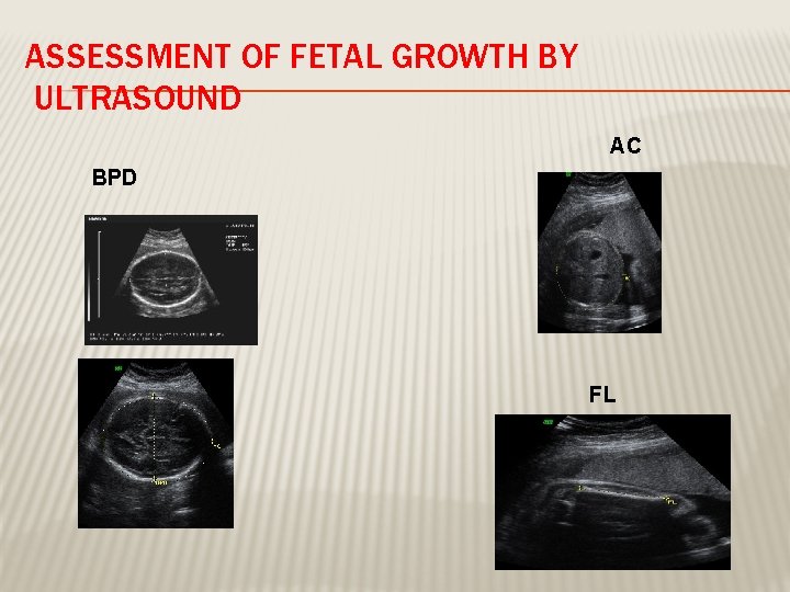 ASSESSMENT OF FETAL GROWTH BY ULTRASOUND AC BPD FL 