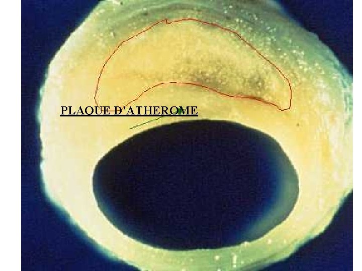 PLAQUE D’ATHEROME 