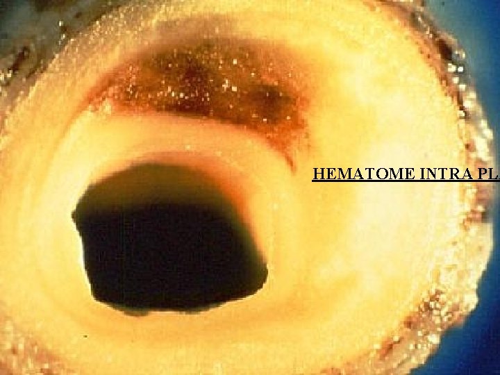 HEMATOME INTRA PLA 