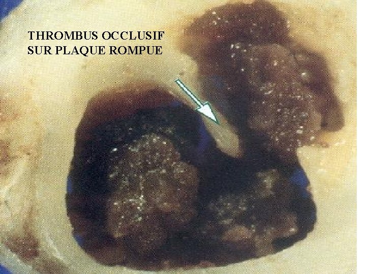 THROMBUS OCCLUSIF SUR PLAQUE ROMPUE 