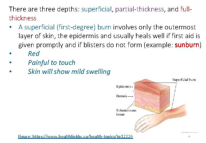 There are three depths: superficial, partial-thickness, and fullthickness • A superficial (first-degree) burn involves