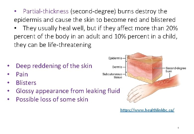  • Partial-thickness (second-degree) burns destroy the epidermis and cause the skin to become