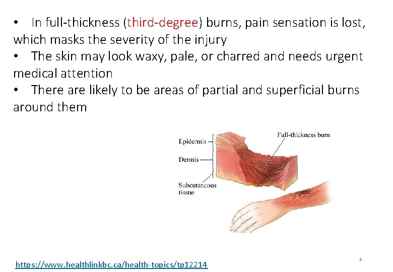  • In full-thickness (third-degree) burns, pain sensation is lost, which masks the severity