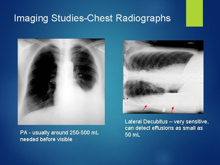 Imaging Studies-Chest Radiographs PA - usually around 250 -500 m. L needed before visible