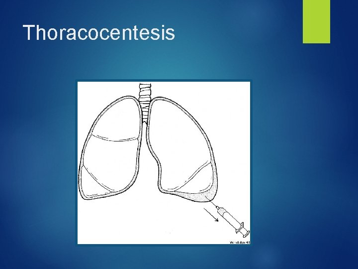 Thoracocentesis 