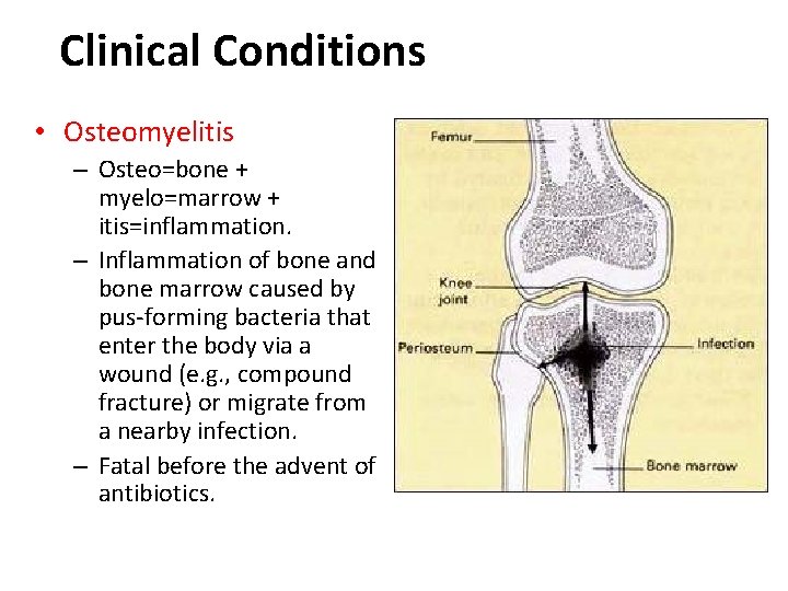 Clinical Conditions • Osteomyelitis – Osteo=bone + myelo=marrow + itis=inflammation. – Inflammation of bone