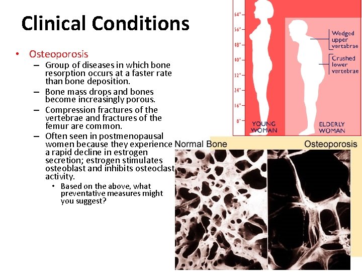 Clinical Conditions • Osteoporosis – Group of diseases in which bone resorption occurs at