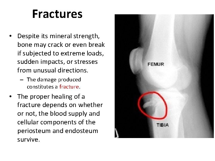 Fractures • Despite its mineral strength, bone may crack or even break if subjected