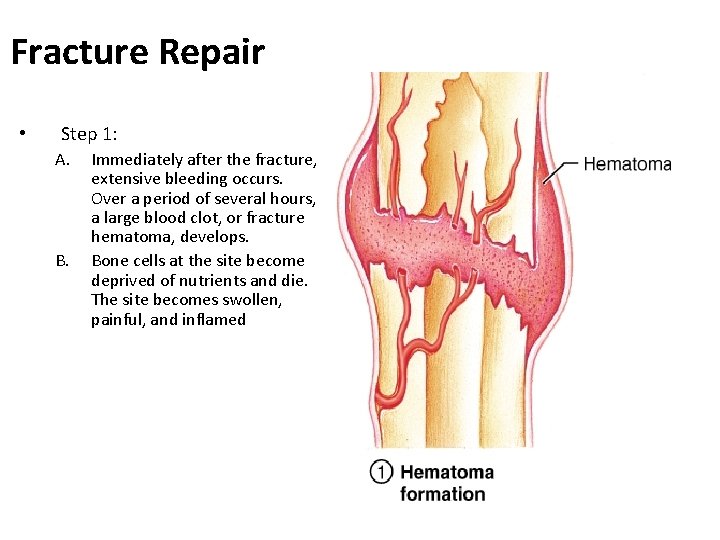 Fracture Repair • Step 1: A. B. Immediately after the fracture, extensive bleeding occurs.
