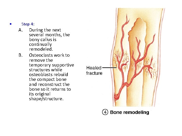  • Step 4: A. B. During the next several months, the bony callus