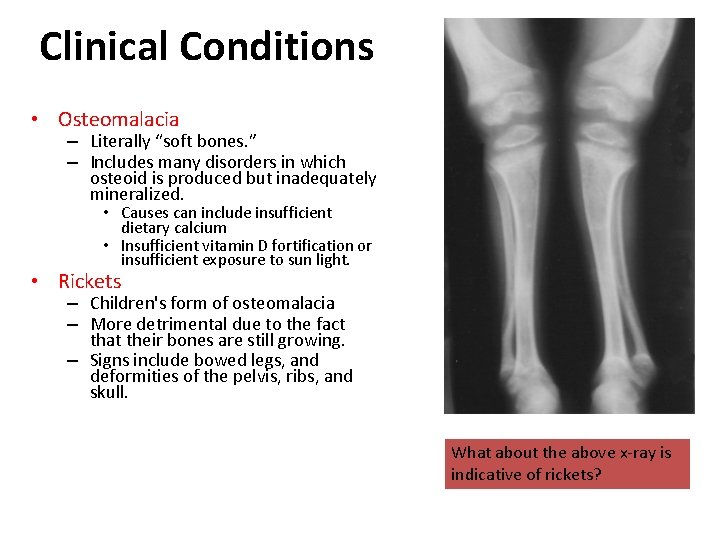 Clinical Conditions • Osteomalacia – Literally “soft bones. ” – Includes many disorders in