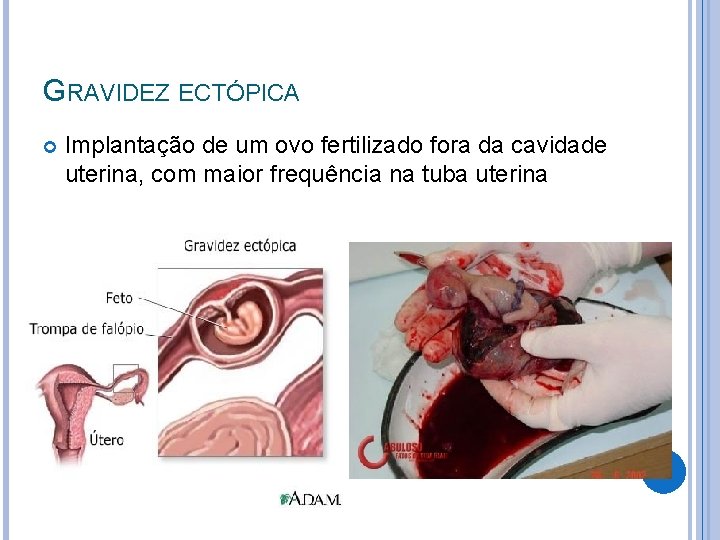 GRAVIDEZ ECTÓPICA Implantação de um ovo fertilizado fora da cavidade uterina, com maior frequência