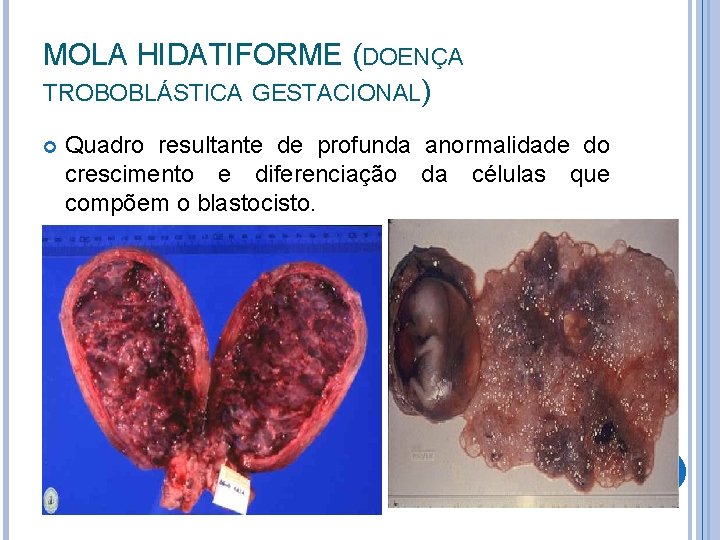 MOLA HIDATIFORME (DOENÇA TROBOBLÁSTICA GESTACIONAL) Quadro resultante de profunda anormalidade do crescimento e diferenciação