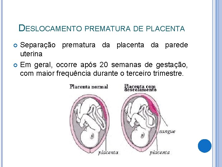 DESLOCAMENTO PREMATURA DE PLACENTA Separação prematura da placenta da parede uterina Em geral, ocorre