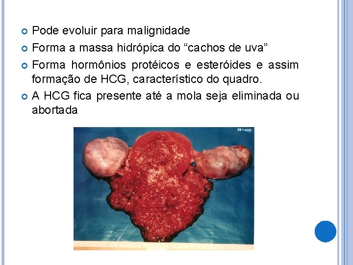 Pode evoluir para malignidade Forma a massa hidrópica do “cachos de uva” Forma hormônios