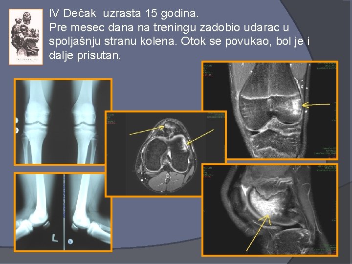 IV Dečak uzrasta 15 godina. Pre mesec dana na treningu zadobio udarac u spoljašnju