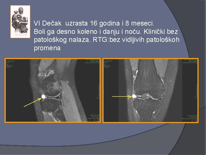 VI Dečak uzrasta 16 godina i 8 meseci. Boli ga desno koleno i danju