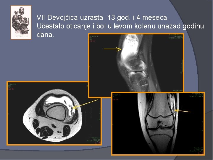 VII Devojčica uzrasta 13 god. i 4 meseca. Učestalo oticanje i bol u levom