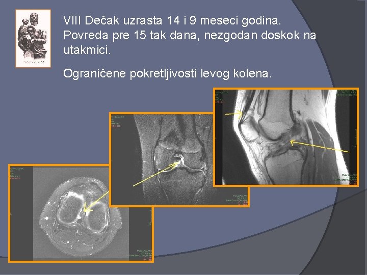 VIII Dečak uzrasta 14 i 9 meseci godina. Povreda pre 15 tak dana, nezgodan