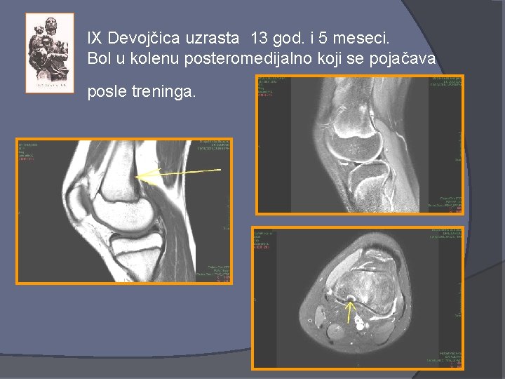 IX Devojčica uzrasta 13 god. i 5 meseci. Bol u kolenu posteromedijalno koji se