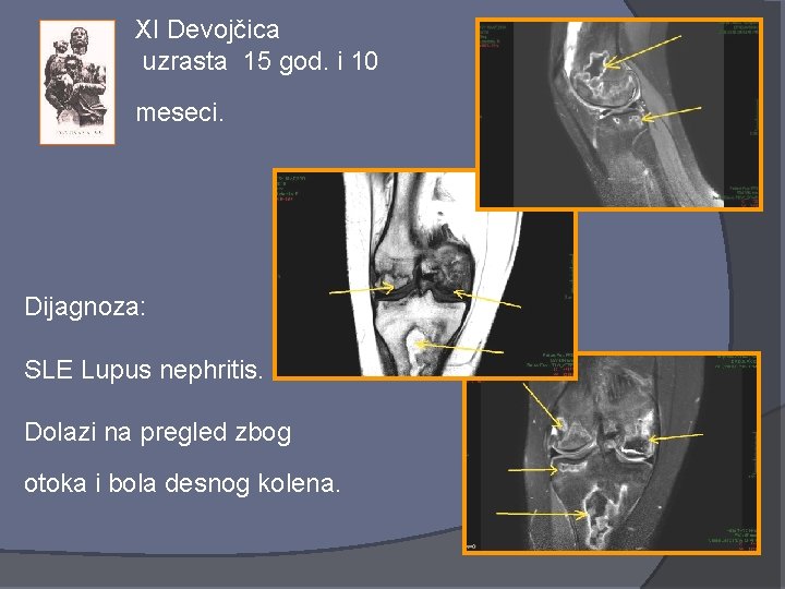 XI Devojčica uzrasta 15 god. i 10 meseci. Dijagnoza: SLE Lupus nephritis. Dolazi na