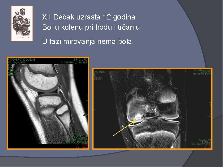 XII Dečak uzrasta 12 godina Bol u kolenu pri hodu i trčanju. U fazi